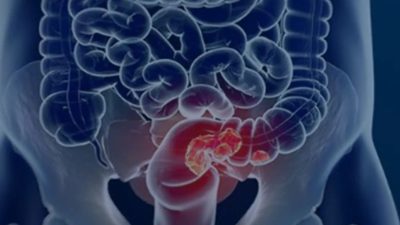 sus-adota-novo-exame-para-rastrear-cancer-colorretal-na-populacao